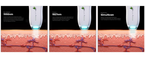 Digital Peel’s dual lasers work simultaneously